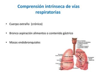 Comprensión intrínseca de vías
respiratorias
• Cuerpo extraño (crónico)
• Bronco aspiración alimentos o contenido gástrico
• Masas endobronquiales
 