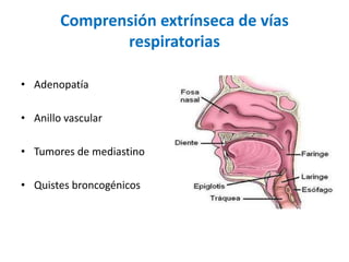 Comprensión extrínseca de vías
respiratorias
• Adenopatía
• Anillo vascular
• Tumores de mediastino
• Quistes broncogénicos
 