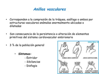 Anillos vasculares
• Corresponden a la compresión de la tráquea, esófago o ambos por
estructuras vasculares anómalas anormalmente ubicadas o
dilatadas
• Son consecuencia de la persistencia o alteración de elementos
primitivos del sistema cardiovascular embrionario
• 3 % de la población general
• Síntomas:
- Estridor
- Sibilancias
- Disfagia
 