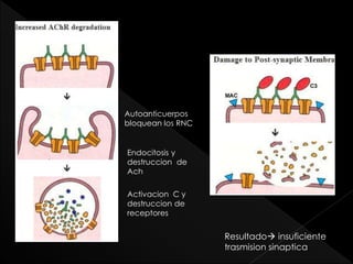 Autoanticuerpos
bloquean los RNC

Endocitosis y
destruccion de
Ach
Activacion C y
destruccion de
receptores

Resultado insuficiente
trasmision sinaptica

 