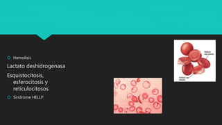  Hemolisis
Lactato deshidrogenasa
Esquistocitosis,
esferocitosis y
reticulocitosos
 Sindrome HELLP
 