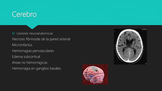Cerebro
 Lesiones neuroanatomicas
Necrosis fibrinoide de la pared arterial
Microinfartos
Hemorragias perivasculares
Edema subcortical
Areas no hemorragicas
Hemorragia en ganglios basales
 