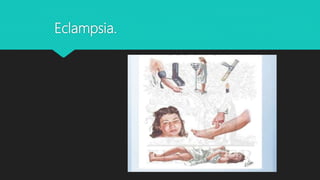 Eclampsia.
 