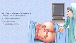 DESCOMPRESIÓN POR COLONOSCOPIA
PUEDE SER ÚTIL EN ALGUNOS CASOS:
 VÓLVULUS DE SIGMOIDES
 INTUSUSCEPCIÓN
 CÁNCER COLORRECTAL
 