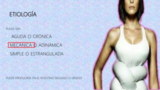 ETIOLOGÍA
PUEDE SER:
• AGUDA O CRÓNICA
• MECÁNICA O ADINÁMICA
• SIMPLE O ESTRANGULADA
PUEDE PRODUCIRSE EN EL INTESTINO DELGADO O GRUESO
 