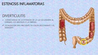 ESTENOSIS INFLAMATORIAS
DIVERTICULITIS
 CONSECUENCIA DE LA ESTENOSIS DE LA LUZ SECUNDARIA AL
ESPASMO, LOS ABSCESOS O LA FIBROSIS.
 LOCALIZACIÓN MÁS FRECUENTE EN COLON DESCENDENTE Y EL
SIGMOIDES
 
