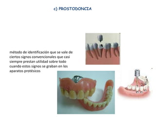 c) PROSTODONCIA




método de identificación que se vale de
ciertos signos convencionales que casi
siempre prestan utilidad sobre todo
cuando estos signos se graban en los
aparatos protésicos
 