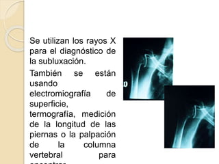 Se utilizan los rayos X
para el diagnóstico de
la subluxación.
También se están
usando
electromiografía de
superficie,
termografía, medición
de la longitud de las
piernas o la palpación
de la columna
vertebral para
 