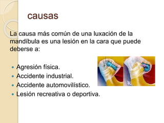 causas
La causa más común de una luxación de la
mandíbula es una lesión en la cara que puede
deberse a:
 Agresión física.
 Accidente industrial.
 Accidente automovilístico.
 Lesión recreativa o deportiva.
 