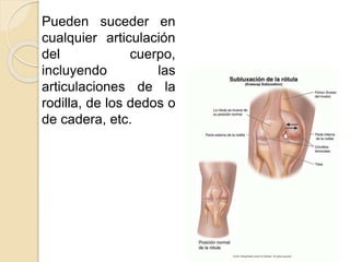 Pueden suceder en
cualquier articulación
del cuerpo,
incluyendo las
articulaciones de la
rodilla, de los dedos o
de cadera, etc.
 