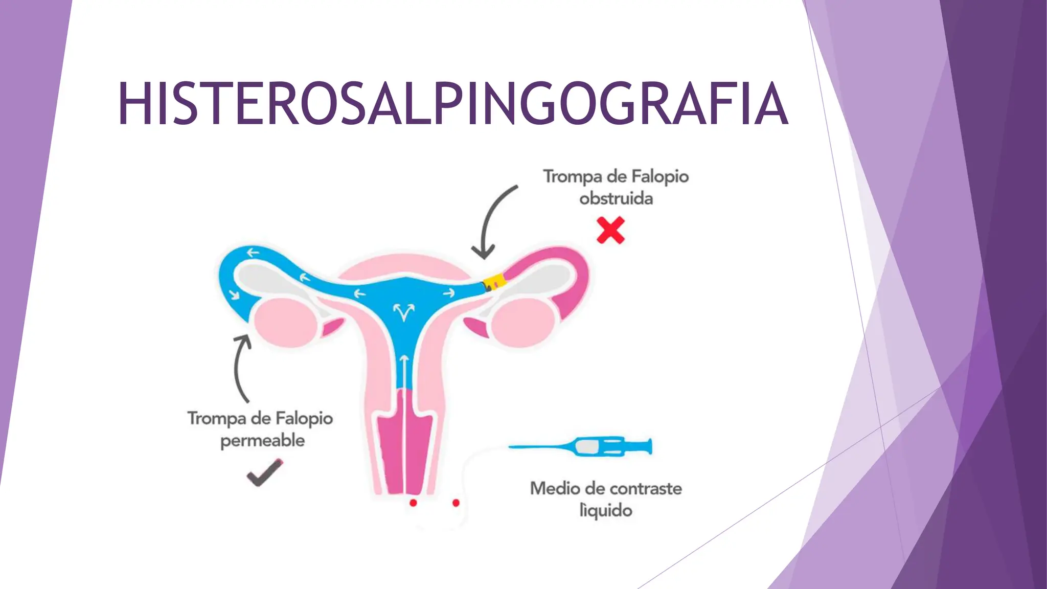 histerosalpingografia-fertilidad-femenina-pptx