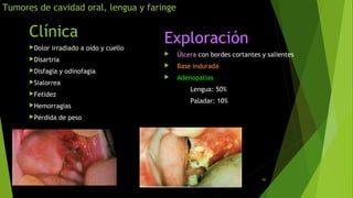 UNIVERSIDA
D CENTRAL
DEL ESTE
Tumores Faríngeos 60
Tumores de cavidad oral, lengua y faringe
Clínica
Dolor irradiado a oído y cuello
Disartria
Disfagia y odinofagia
Sialorrea
Fetidez
Hemorragias
Pérdida de peso
Exploración
 Úlcera con bordes cortantes y salientes
 Base indurada
 Adenopatías
Lengua: 50%
Paladar: 10%
 