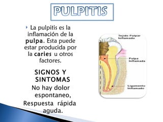 La pulpitis es la inflamación de la  pulpa . Esta puede estar producida por la  caries  u otros factores. SIGNOS Y SINTOMAS No hay dolor espontaneo, Respuesta  rápida  aguda. 
