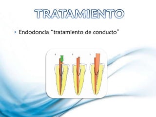 Endodoncia “tratamiento de conducto ” 