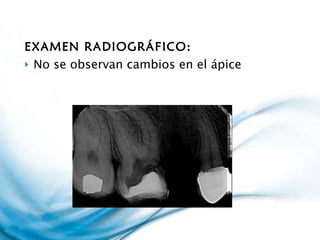 EXAMEN RADIOGRÁFICO: No se observan cambios en el ápice 