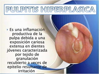Es una inflamación productiva de la pulpa debida a una exposición cariosa extensa en dientes jóvenes caracterizada por tejido de granulación recubierto a veces de epitelio resultante de irritación    