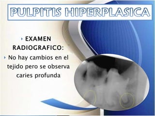 EXAMEN RADIOGRAFICO: No hay cambios en el tejido pero se observa  caries profunda  