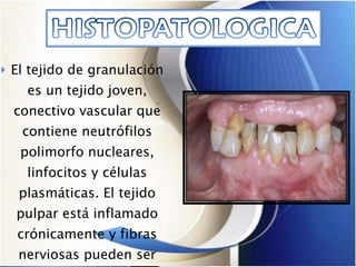 El tejido de granulación es un tejido joven, conectivo vascular que contiene neutrófilos polimorfo nucleares, linfocitos y células plasmáticas. El tejido pulpar está inflamado crónicamente y fibras nerviosas pueden ser encontradas en la capa epitelial.  