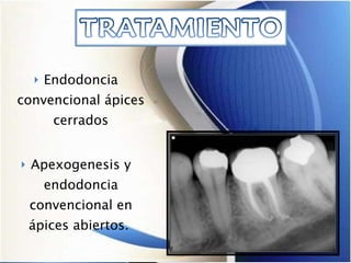 Endodoncia convencional ápices cerrados Apexogenesis y endodoncia convencional en ápices abiertos.  