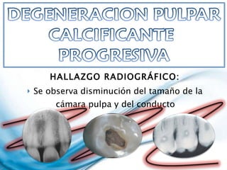 HALLAZGO RADIOGRÁFICO: Se observa disminución del tamaño de la cámara pulpa y del conducto  