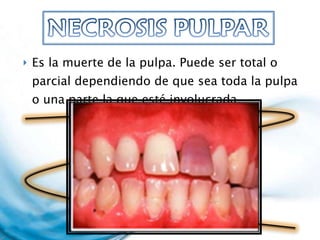 Es la muerte de la pulpa. Puede ser total o parcial dependiendo de que sea toda la pulpa o una parte la que esté involucrada.  