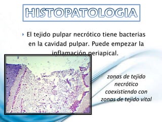 El tejido pulpar necrótico tiene bacterias en la cavidad pulpar. Puede empezar la inflamación periapical.  zonas de tejido necrótico coexistiendo con zonas de tejido vital 