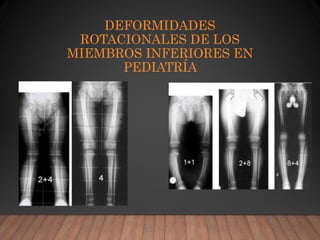 DEFORMIDADES
ROTACIONALES DE LOS
MIEMBROS INFERIORES EN
PEDIATRÍA
 