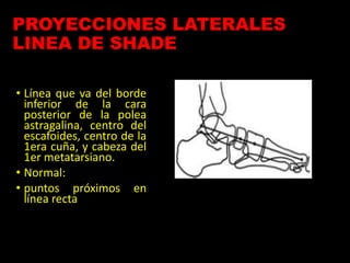 PROYECCIONES LATERALES
LINEA DE SHADE
• Línea que va del borde
inferior de la cara
posterior de la polea
astragalina, centro del
escafoides, centro de la
1era cuña, y cabeza del
1er metatarsiano.
• Normal:
• puntos próximos en
línea recta
 