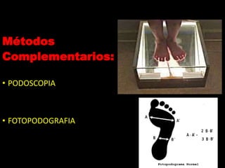 Métodos
Complementarios:
• PODOSCOPIA
• FOTOPODOGRAFIA
 
