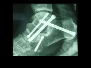 pie plano final final