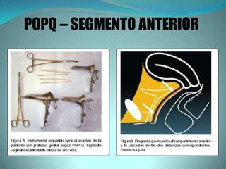 POPQ – SEGMENTO ANTERIOR
 