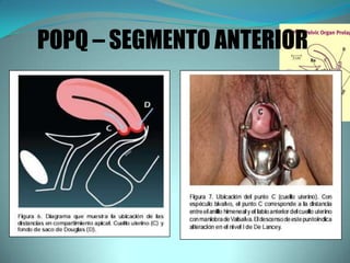 POPQ – SEGMENTO ANTERIOR
 