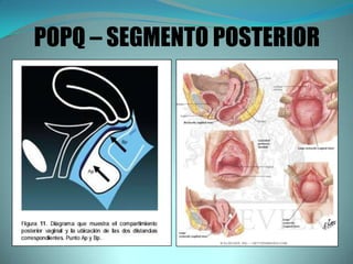POPQ – SEGMENTO POSTERIOR
 