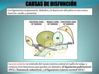 La zona anterior se extiende del meato externo uretral al cuello de vejiga, y
contiene tres estructuras que pueden ser dañados: el ligamento pubouretral
(PUL), Hammock suburetral, y el ligamento externo uretral (EUL)
CAUSAS DE DISFUNCIÓN
Los ligamentos suspensorios dañados y la fascia son ubicados en tres zonas:
Anterior, medio y posterior.
 