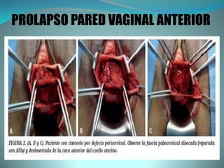PROLAPSO PARED VAGINAL ANTERIOR
 