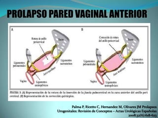 PROLAPSO PARED VAGINAL ANTERIOR
Palma P, Ricetto C, Hernandez M, Olivares JM Prolapsos
Urogenitales: Revisión de Conceptos – Actas Urológicas Españolas
2008;32(6):618-623
 