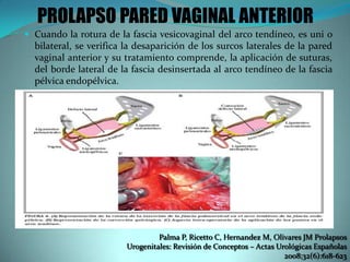 PROLAPSO PARED VAGINAL ANTERIOR
 Cuando la rotura de la fascia vesicovaginal del arco tendíneo, es uni o
bilateral, se verifica la desaparición de los surcos laterales de la pared
vaginal anterior y su tratamiento comprende, la aplicación de suturas,
del borde lateral de la fascia desinsertada al arco tendíneo de la fascia
pélvica endopélvica.
Palma P, Ricetto C, Hernandez M, Olivares JM Prolapsos
Urogenitales: Revisión de Conceptos – Actas Urológicas Españolas
2008;32(6):618-623
 