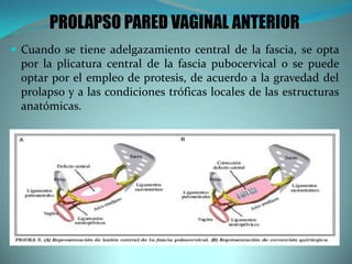 PROLAPSO PARED VAGINAL ANTERIOR
 Cuando se tiene adelgazamiento central de la fascia, se opta
por la plicatura central de la fascia pubocervical o se puede
optar por el empleo de protesis, de acuerdo a la gravedad del
prolapso y a las condiciones tróficas locales de las estructuras
anatómicas.
 