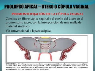 PROLAPSO APICAL – UTERO O CÚPULA VAGINAL
PROMONTOFIJACIÓN DE LA CÚPULA VAGINAL
Consiste en fijar el ápice vaginal o el cuello del útero en el
promontorio sacro, con la interposición de una malla de
material sintético.
Vía convencional o laparoscópica.
 