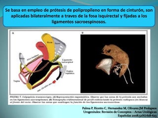 Se basa en empleo de prótesis de polipropileno en forma de cinturón, son
aplicadas bilateralmente a traves de la fosa isquirectal y fijadas a los
ligamentos sacroespinosos.
Palma P, Ricetto C, Hernandez M, Olivares JM Prolapsos
Urogenitales: Revisión de Conceptos – Actas Urológicas
Españolas 2008;32(6):618-623
 