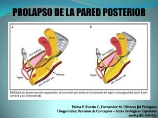 PROLAPSO DE LA PARED POSTERIOR
Palma P, Ricetto C, Hernandez M, Olivares JM Prolapsos
Urogenitales: Revisión de Conceptos – Actas Urológicas Españolas
2008;32(6):618-623
 