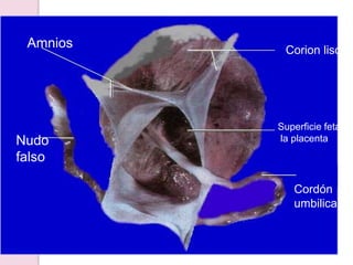 Superficie fetal de
la placenta
Cordón
umbilical
Amnios
Nudo
falso
Corion liso
 