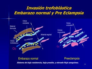11
Invasión trofoblástica
Embarazo normal y Pre Eclampsia
Célula
endotelial
Célula
trofoblástica
Material
fibrinoide
Arterial espiral
O2
Embarazo normal
Célula
endotelial
Células
musculares
O2
Preeclampsia
Sistema de baja resistencia, baja presión, y elevado flujo sanguíneo.
 