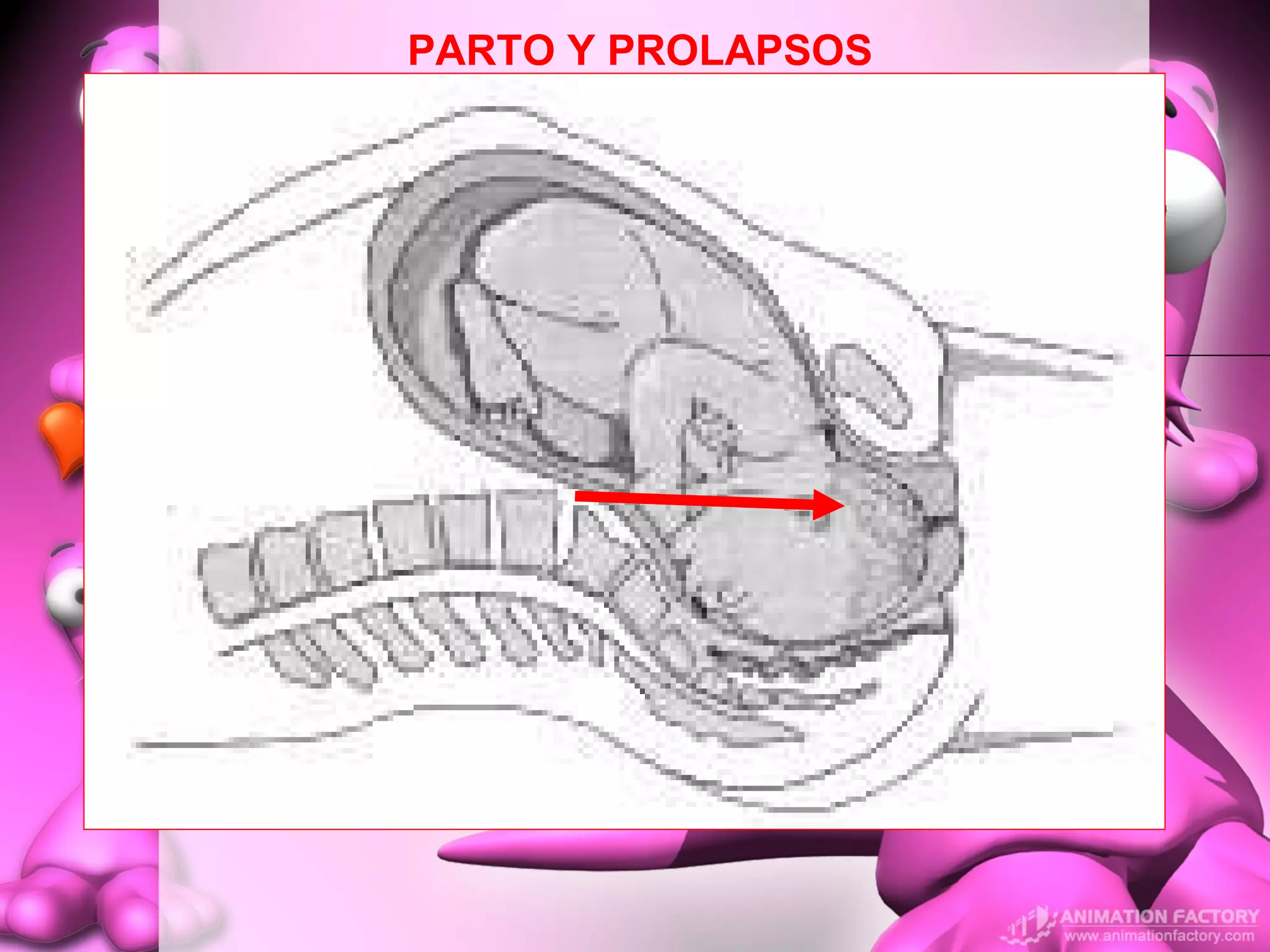 Prolapzo prolapso genital | PPT