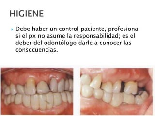  Debe haber un control paciente, profesional
si el px no asume la responsabilidad; es el
deber del odontólogo darle a conocer las
consecuencias.
 