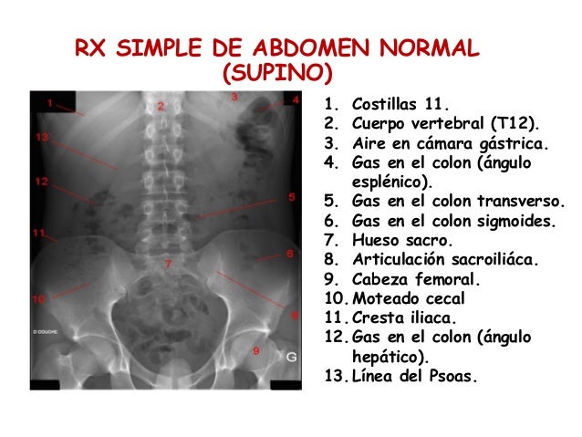 RADIOGRAFIA ABDOMINAL RADIOGRAFIA ABDOMINAL