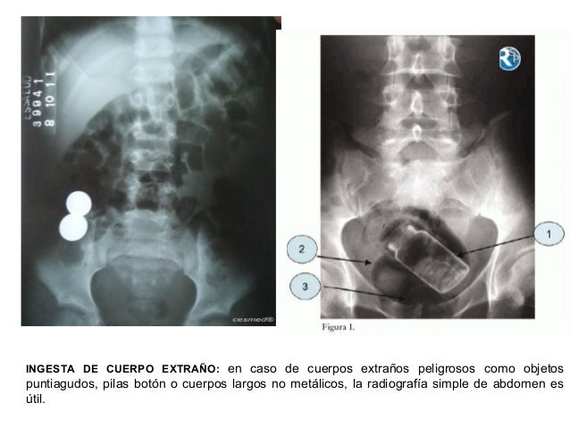 Radiograf a abdominal MedlinePlus enciclopedia m dica