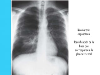 Neumotórax
   espontáneo.

Identificación de la
     línea que
 corresponde a la
  pleura visceral
 