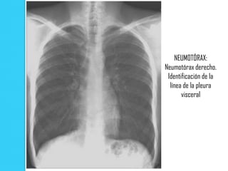 NEUMOTÓRAX:
Neumotórax derecho.
 Identificación de la
  línea de la pleura
       visceral
 
