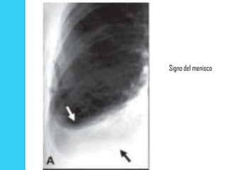 Signo del menisco
 